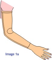 Pressure Garments lymphedema