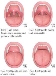 Sleep apnea